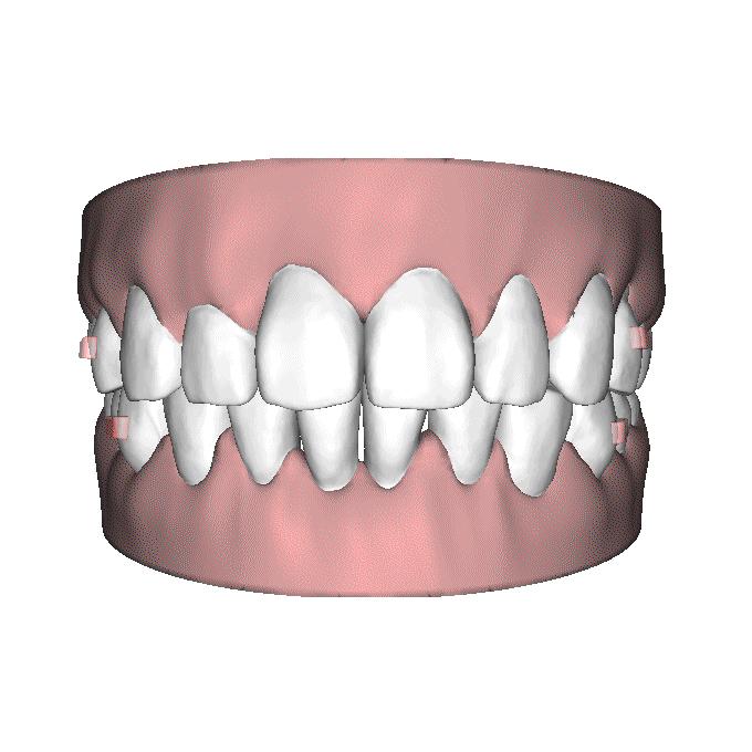 自锁托槽和隐形矫治器哪个效果好,无托槽隐形矫治器效果好吗
