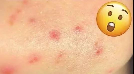 该怎样从源头上改善成人痘印痘坑,祛红痘印黑痘印医美