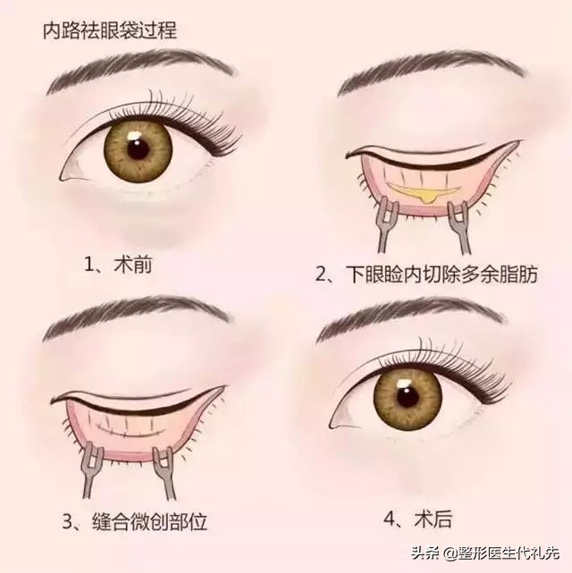 聊一聊35岁外切祛眼袋案例，为什么选择了外切而没有内切祛眼袋