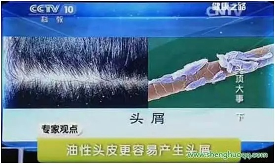 头发油头痒头屑多用什么药,头发油头屑多掉发用什么洗发水