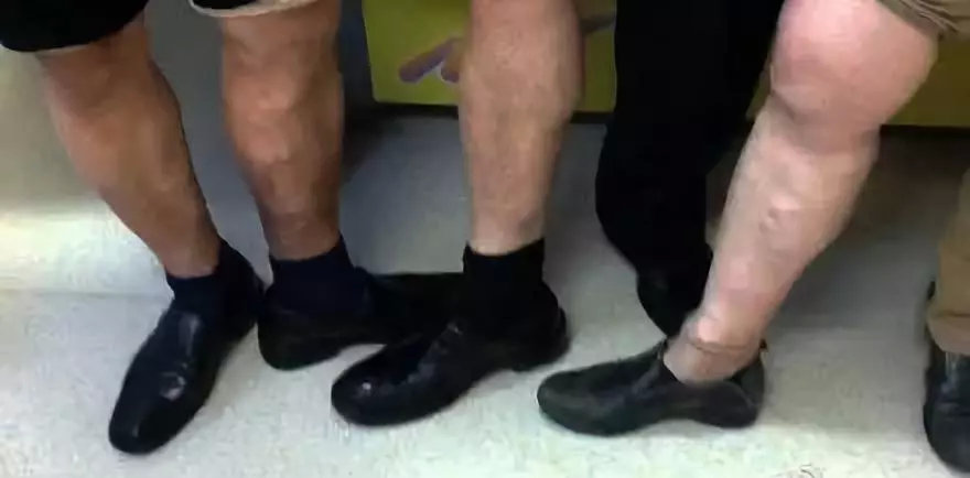 腿上有静脉曲张能生孩子么,20岁腿上有静脉曲张影响生活吗