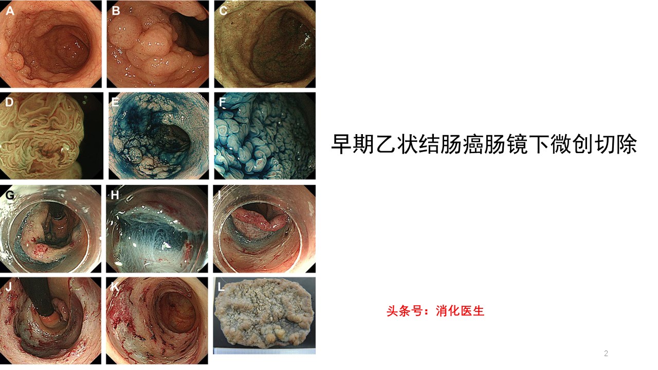 溃疡性结肠炎导致肠癌,溃疡性结肠炎与肠癌症状