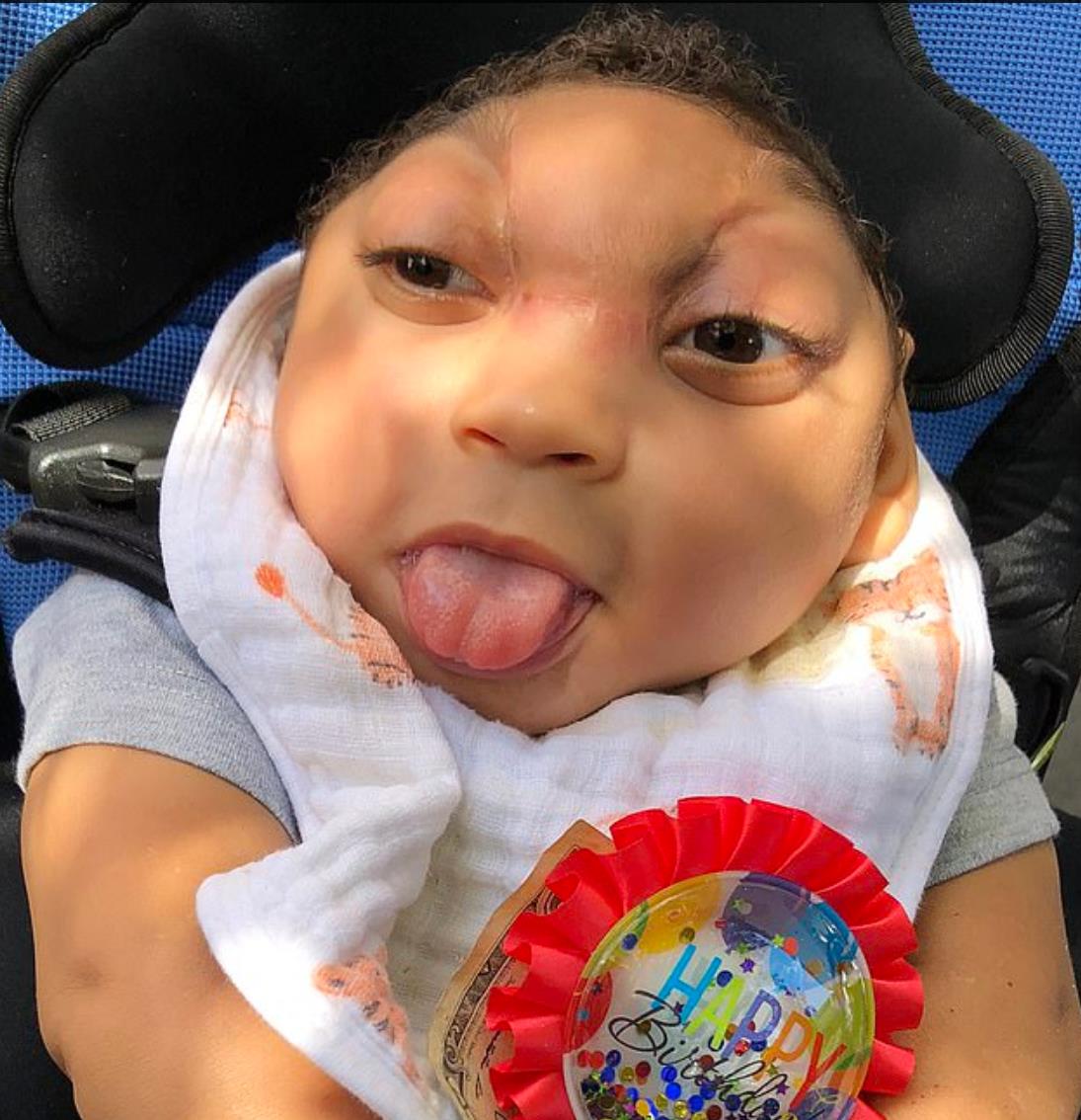 小头畸形的孩子能活多久,孩子出生畸形可以放弃吗