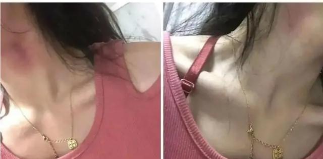 发现女友身上有吻痕该怎么办,女友颈部有吻痕