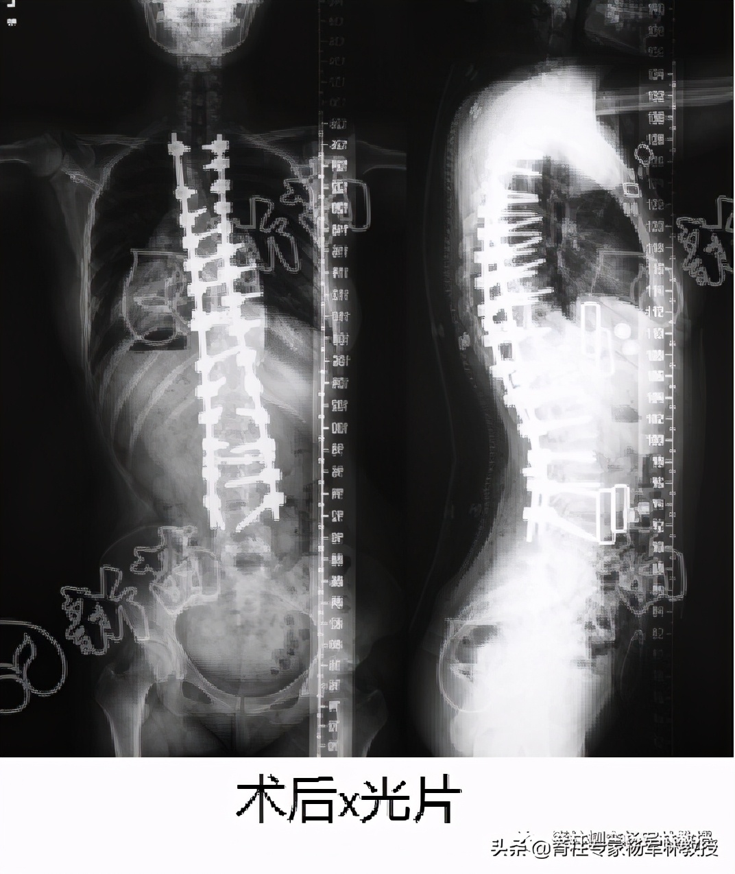 女高中生脊柱侧弯治疗视频,15岁女生脊柱侧弯能自愈吗