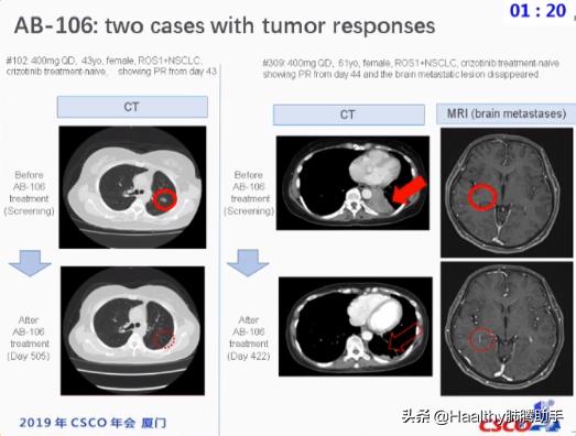 ros1阳性 (ros1阳性生存期超10年)