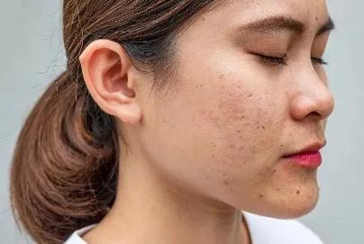 享“瘦”胶原，青春无限