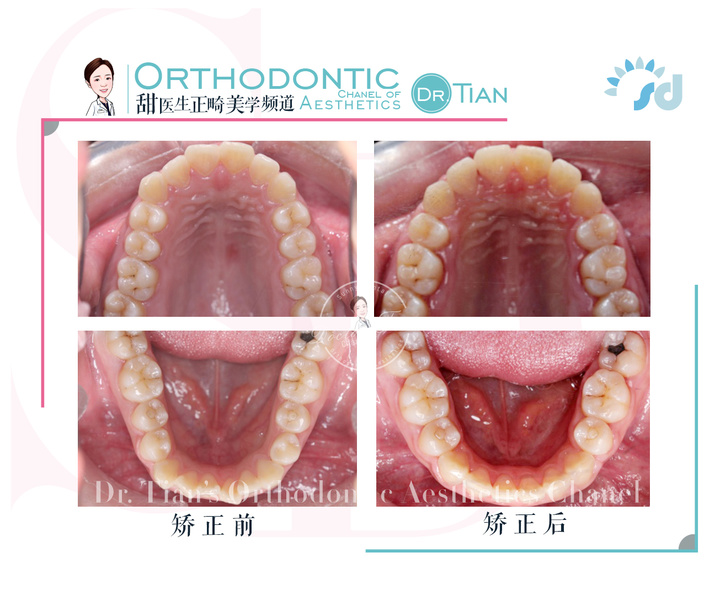 47岁大龄矫正,骨性嘴突+牙缝大+牙周炎|曹博士正畸复杂病例分享