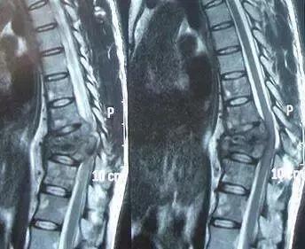 脊柱结核是怎么回事,健康科普不该被忽视的脊柱结核