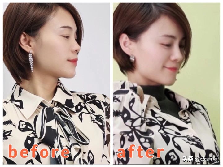 熬夜写完了医美后续，美真的是要付出代价的