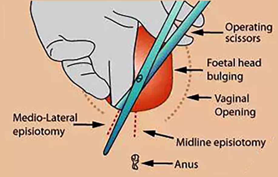 生孩子是必须要住院吗,女人顺产必须侧切吗