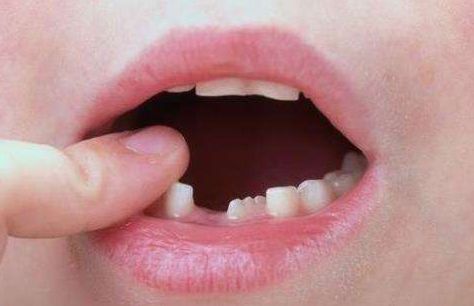 孩子乳牙迟迟不掉怎么办,儿童拔掉乳牙迟迟不长怎么办呢