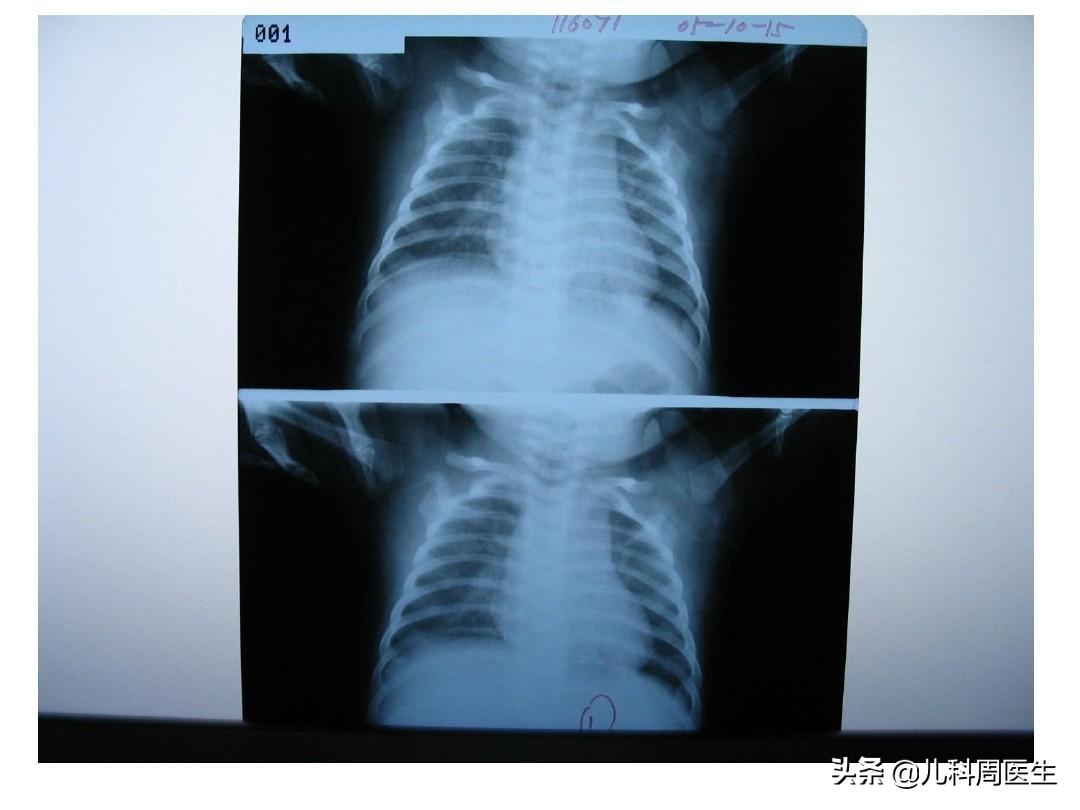宝宝肺炎三凹征喘气是什么样的,婴儿毛细支气管炎憋喘急救措施