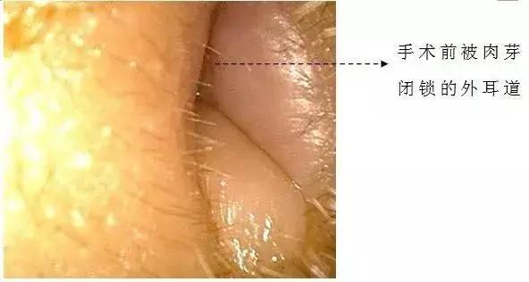 “耳屎”太多被同事吐槽!杭州漂亮姑娘去医院一查,吓得直掉眼泪