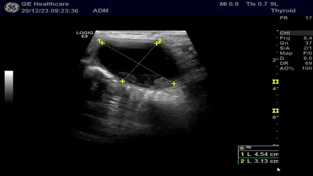 甲状腺囊肿介入,甲状腺囊肿介入治疗效果如何
