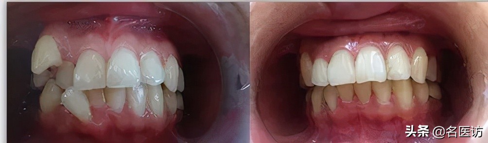 牙齿矫正不戴保持器会全部反弹吗,牙齿矫正保持器戴久了脸会变形吗