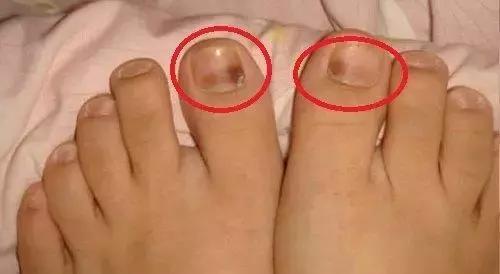 跑步为什么有黑指甲,跑步黑脚趾怎么办