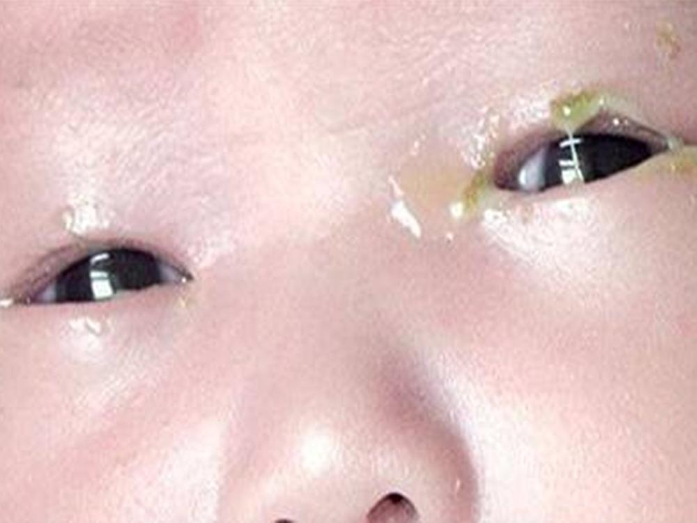 儿科医生宝宝眼睛有眼屎,小宝宝眼屎多又黄是怎么回事