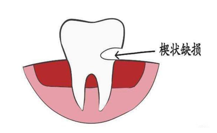 横着刷牙牙齿磨损能补吗,横向刷牙牙根磨损严重怎么修复