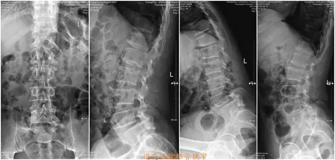 椎间盘突出和椎管狭窄症状的区别,腰椎管狭窄症的症状