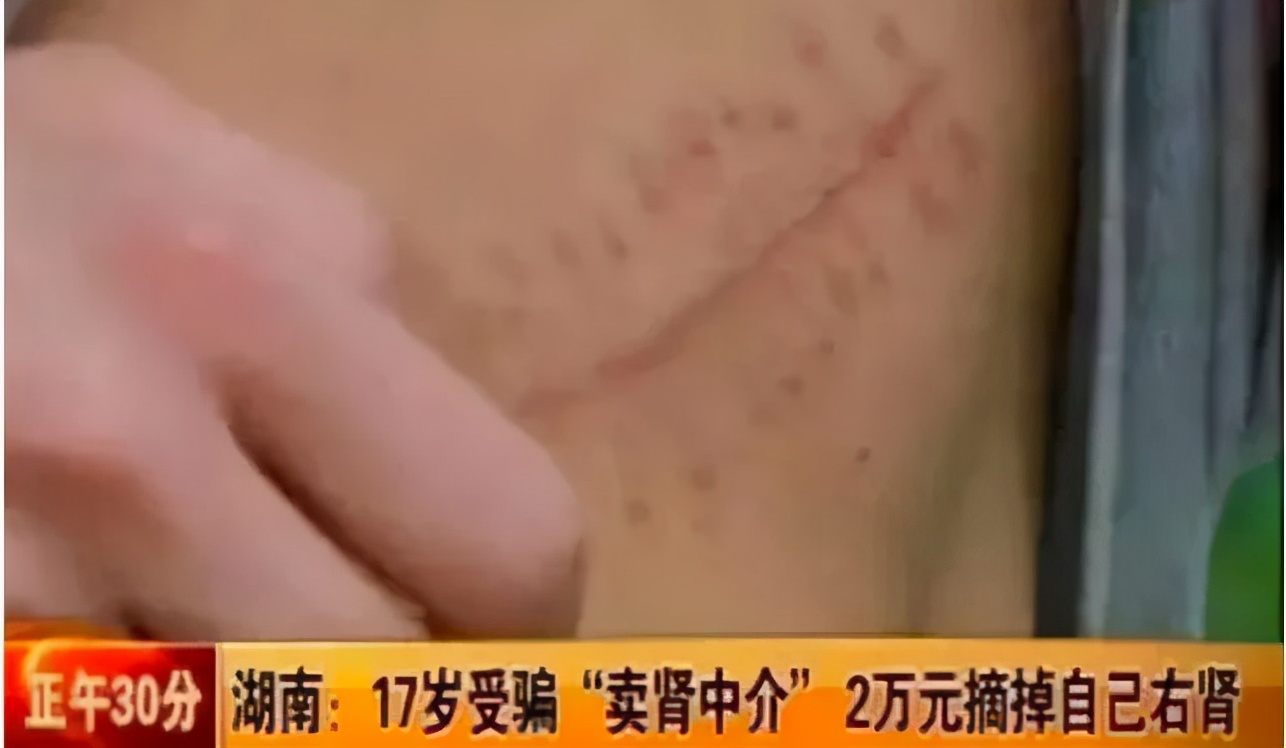 10年前卖肾少年卖苹果手机,高中生卖肾换苹果手机事件