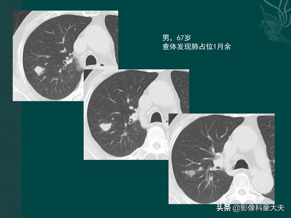 这5种癌一发现就是晚期,第一例癌症患者治愈