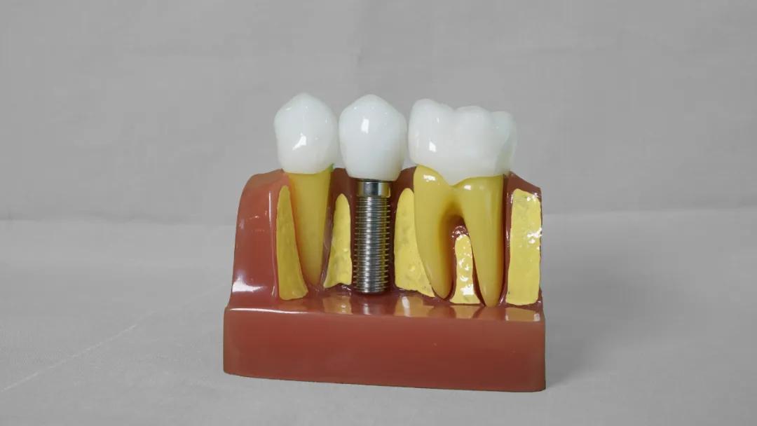 种牙真实过程,种牙是拧螺丝吗