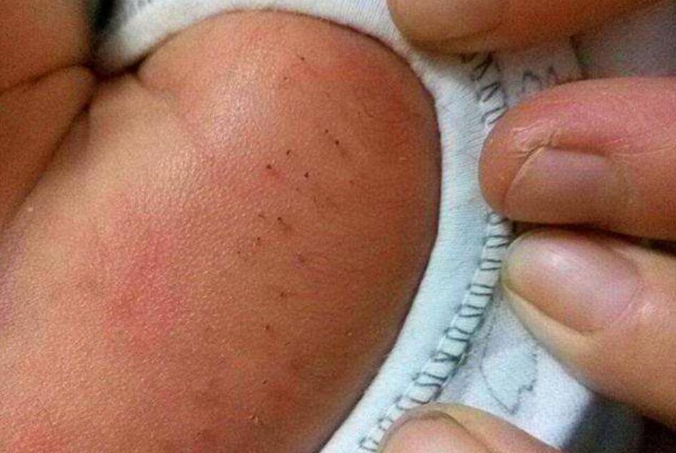 宝宝身上长黑刺妈妈一根根的拔掉,孩子身上长了黑刺