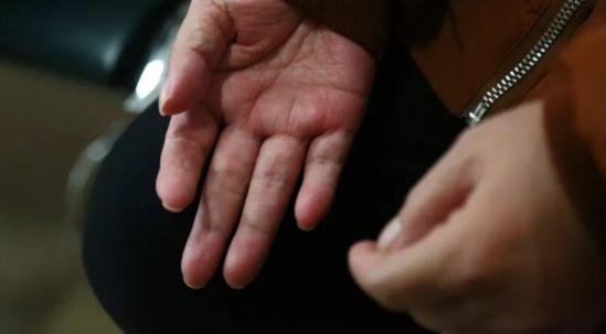 脑梗手动不了,脑梗手动不了关节会肿吗