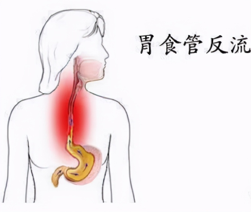 难治性胃食管反流病的处理策略,难治性食管反流病处理方法