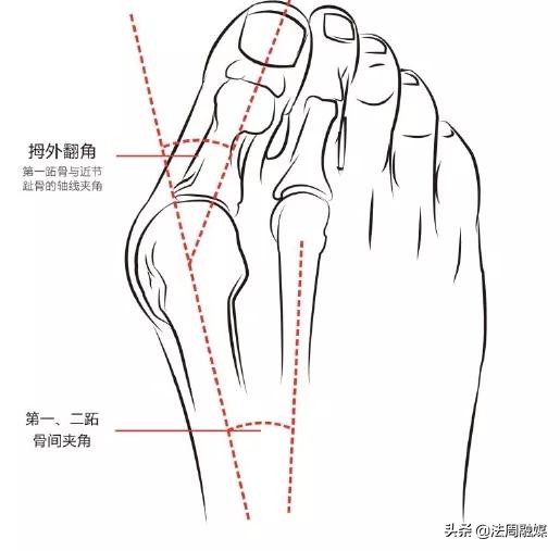 拇指长歪了?别慌!常德市第一中医医院专家帮您改“邪”归正