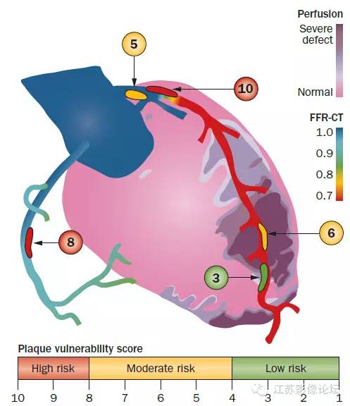 冠脉CT血管造影诊断高危斑块病变影像学特征分析