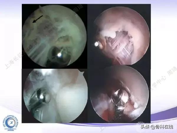肘关节镜手术后引流,肘关节镜微创手术