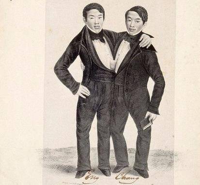 中国连体双胞胎兄弟,连体兄弟中国