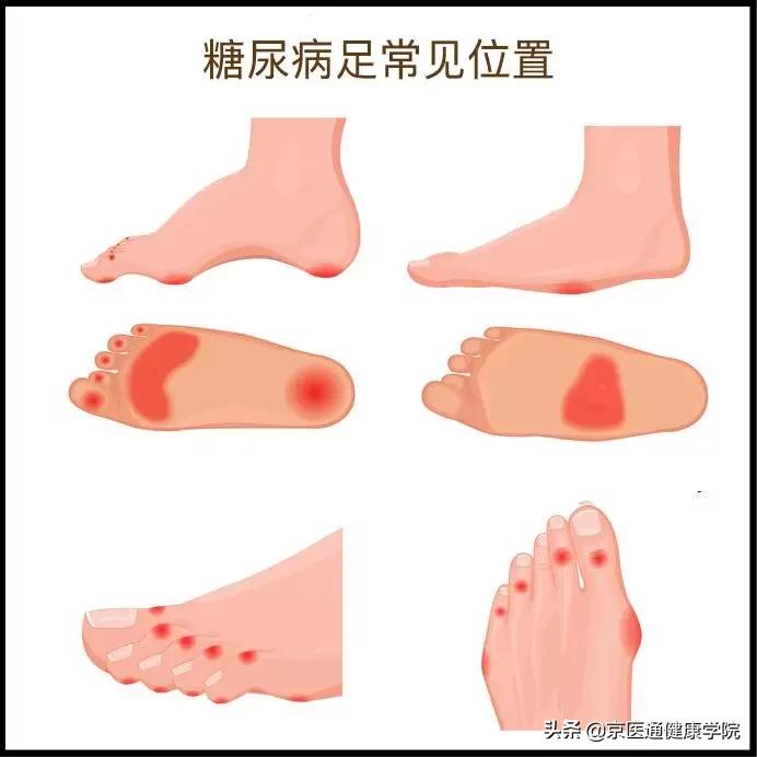 糖尿病最怕「糖尿病足」的出现或加重，专家教你6招巧预防