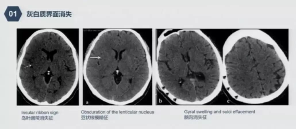 急性脑中风影像诊断选择,急性脑卒中首选哪种检查方法