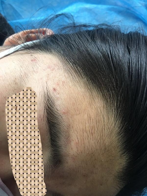 美肤店脱毛女孩,几岁去美容院脱毛