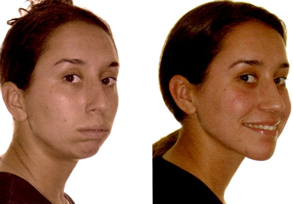 下巴短小怎么办不整容可以改变吗,下巴短后缩下颌线不明显怎么改善