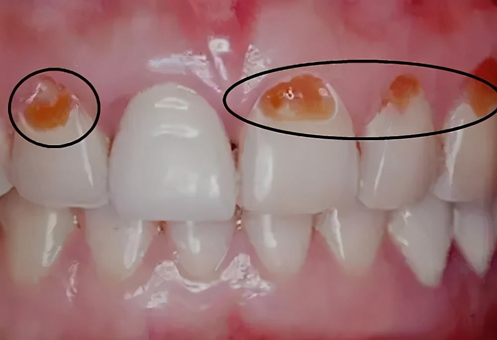 牙齿咬东西酸软无力用什么牙膏,牙齿酸软恢复小妙招真的有用吗