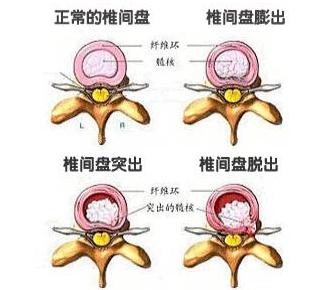 腰间盘膨出最佳疗法,腰间盘膨出中医怎么治