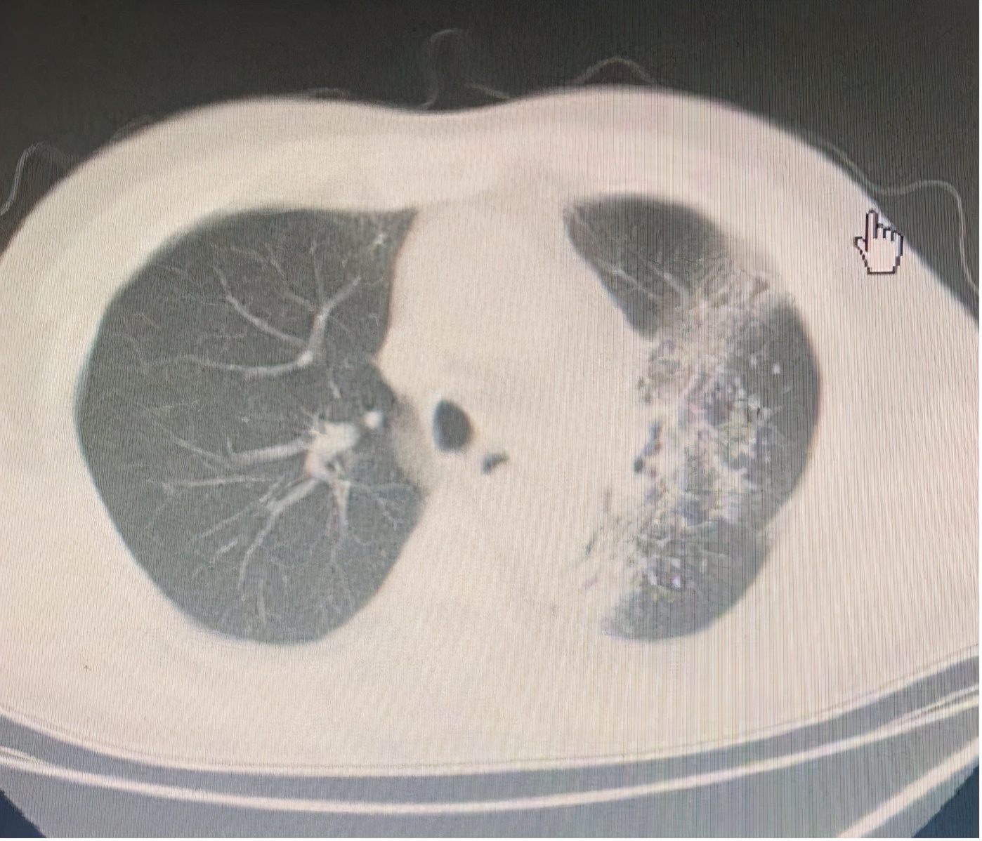 肺癌放疗后的放射性肺炎严重吗,放疗之后放射性肺炎多久能显现