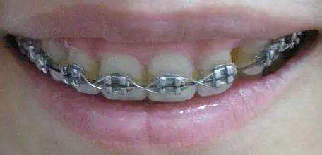 口腔医生科普牙套如何选择,青岛牙齿矫正哪种牙套好