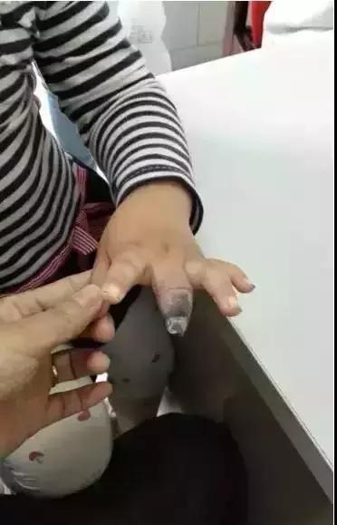 创口贴要是不适合贴会什么样子,创口贴是不是真的没用