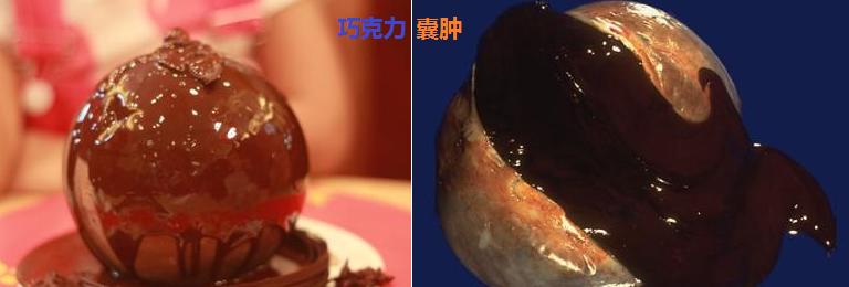 卵巢巧克力囊肿穿刺好还是手术好,穿刺治疗巧克力囊肿效果评价