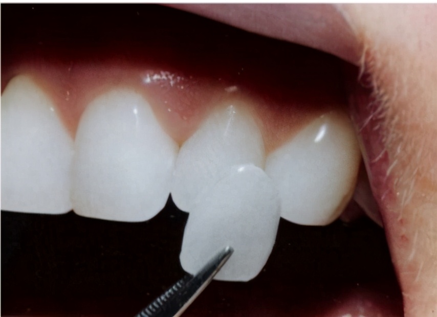 牙齿脱矿了如何补救,牙齿脱矿了怎么治