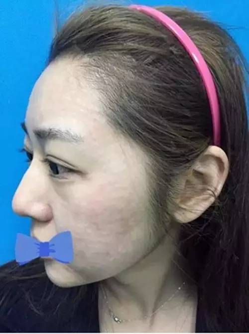 把水光针当饭吃？这位网红简直丧心病狂！整容后年入千万