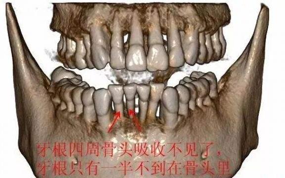 牙槽骨吸收牙根露出来怎么办,牙槽骨暴露会导致牙槽骨吸收吗