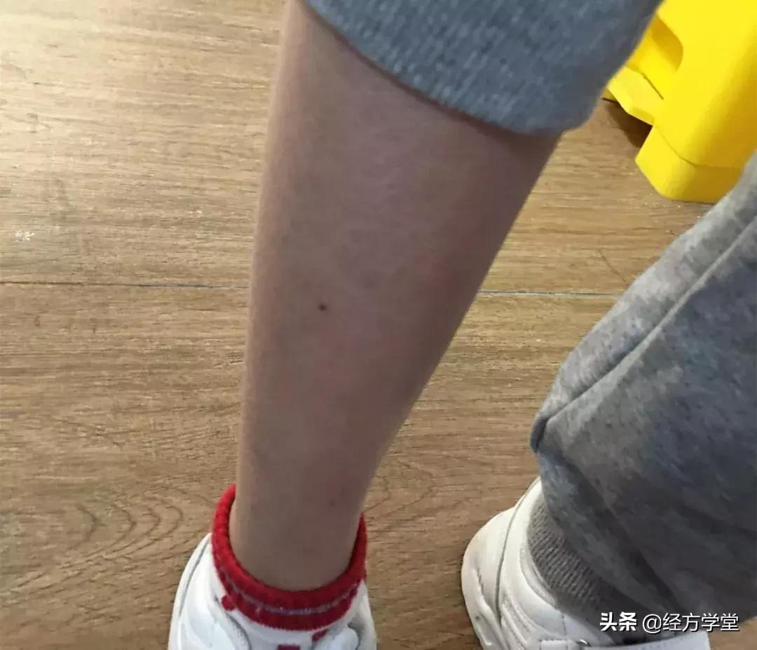 小儿感冒久治不好,小儿感冒反复发烧怎么办