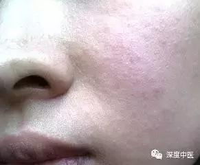 中医治过敏最好方法,中医告诉你过敏本质及治愈办法