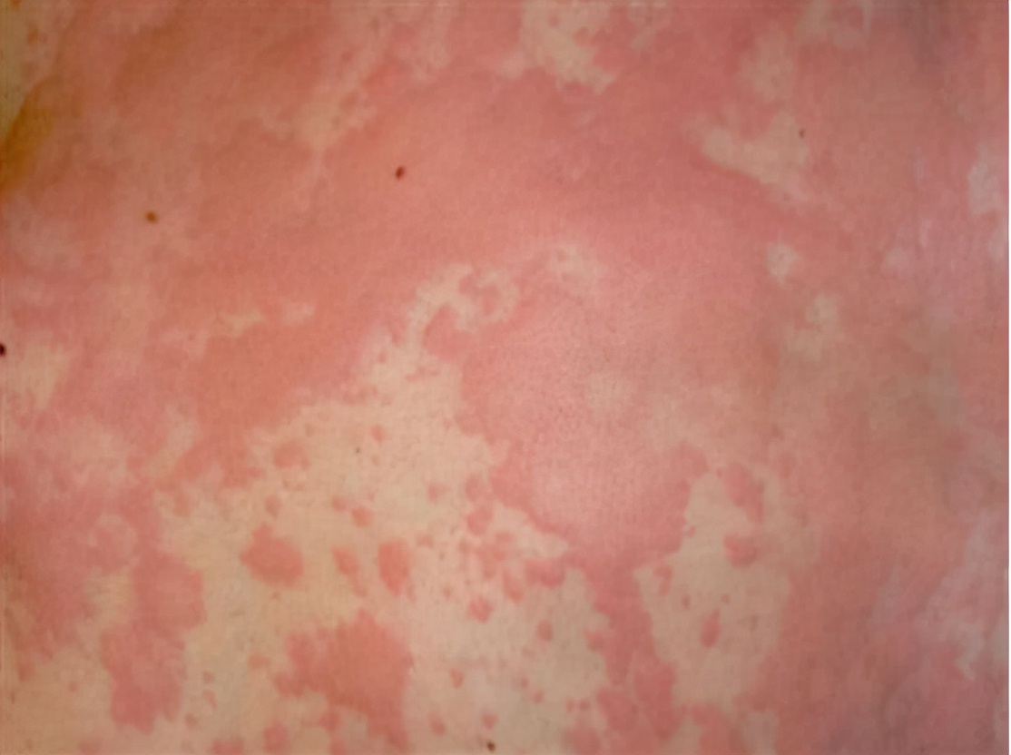 荨麻疹缓解瘙痒的方法是什么,荨麻疹瘙痒难忍可以用什么缓解